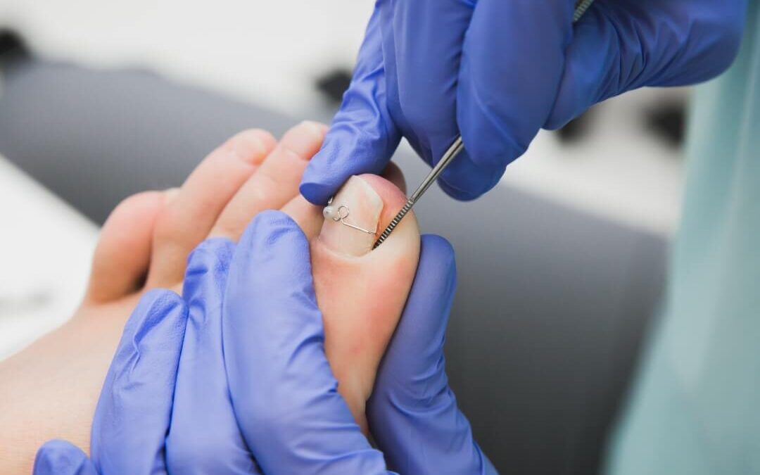 Ingrown Toenail Treatment for Seniors in Cambridge: Safe In-Home Solutions