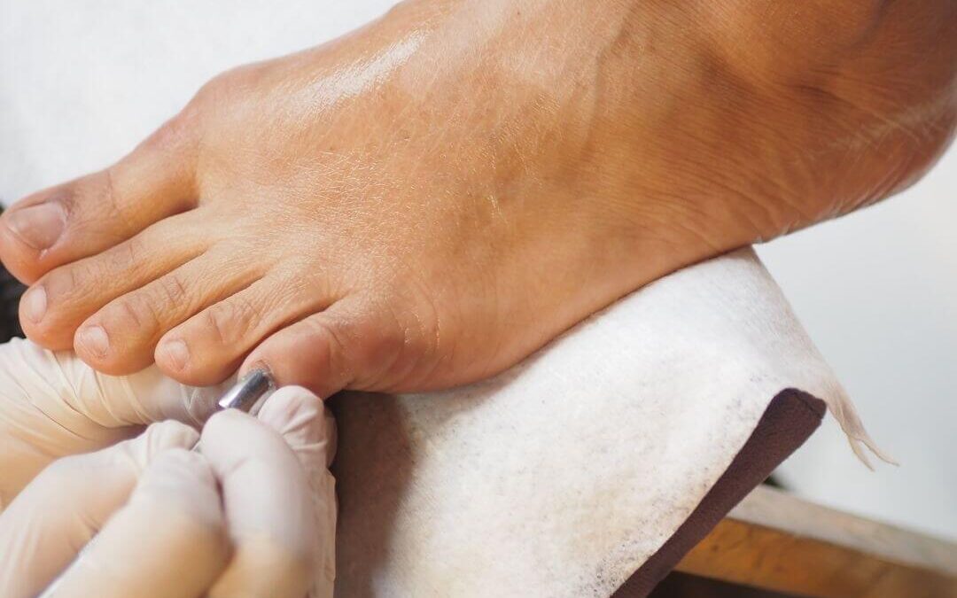 Post-Surgery Foot Care for Seniors in Brantford: Mobile Podology During Recovery